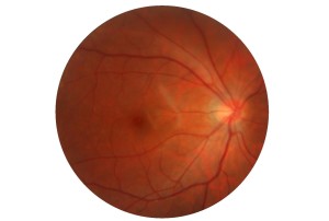 Normal Retinal