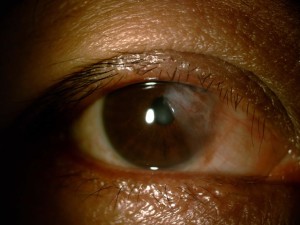 Pterygium