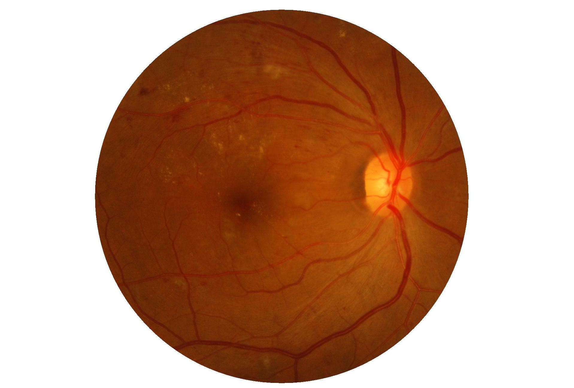 Retinal showing Blot Haemorhages and Exudates